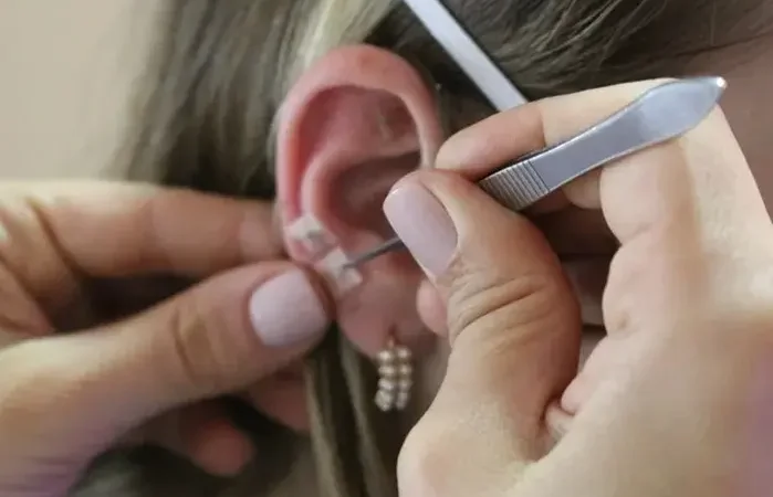 Acupuntura agora e uma profissao regulamentada