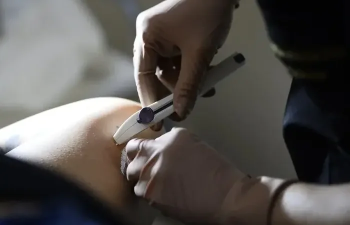 Sistema de Saude Publica Oferece Implante Contraceptivo Implanon